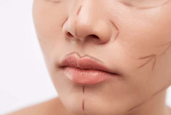 yüz germe (face lift)