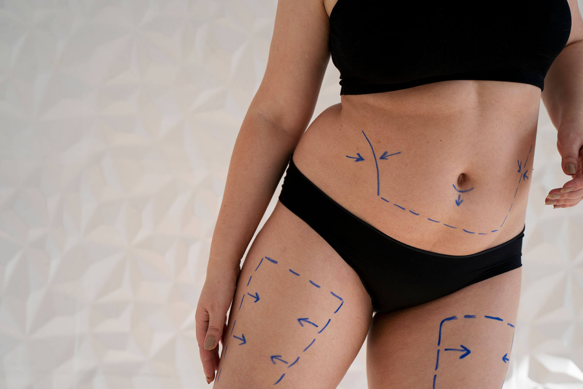 Liposuction Yağ Aldırma